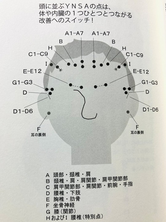 YNSA 山元式新頭針療法 鍼灸 頭皮鍼 ツボ 頭鍼・YNSA 山元式新頭鍼療法 三島市のコンディショニング